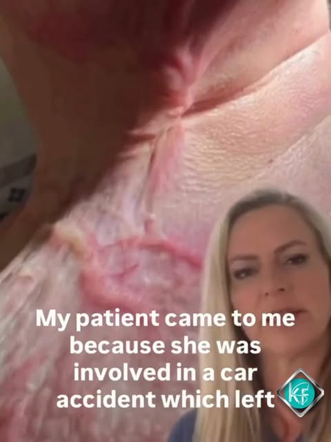 A courageous patient came to Kelly after surviving a devastating car accident that caused severe bur