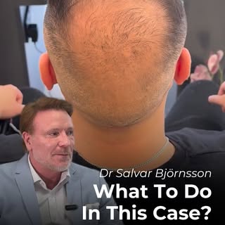 Our CEO @salvar.vinci breaks down a case where the patient appears to have had a previous hair trans