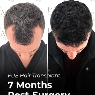 Hair Transplant Before and After: Real Results from Vinci Hair Clinic

After living with hair loss f