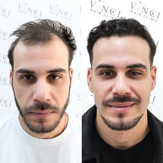 Boa densidade, naturalidade e um resultado que ele mesmo elogiou. Essa é a história de Kayky, pacien