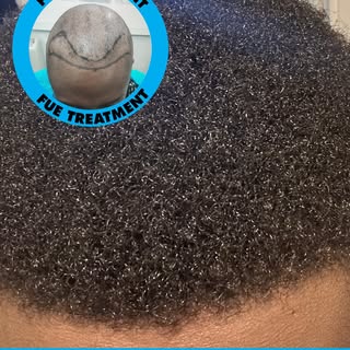 6 Months postop results - Afro hair transplant