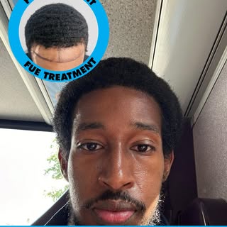 Afro Fue hair transplant.
Book your free consultation now at mycosmeticcentre.com