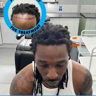 Another Successful Afro Fue Hair Transplant.
Book yourself for a free consultation at www.mycosmetic