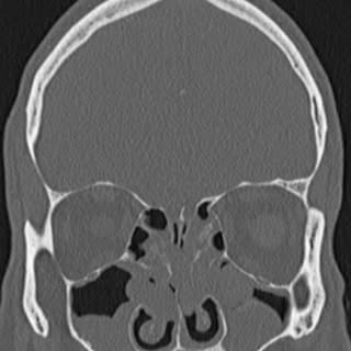 Struggling with chronic congestion or repeat sinus infections? A sinus CT may be the key to pinpoint