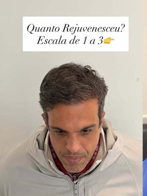 ESCALA WELLS DE REJUVENESCIMENTO — GRAU 3

Nem todo transplante capilar produz o mesmo impacto na ap