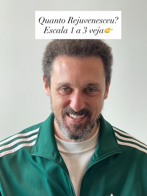 Quanto um transplante capilar pode rejuvenescer uma pessoa?

Na Escala Wells de Rejuvenescimento, cl