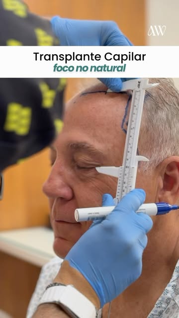 Um transplante capilar natural começa muito antes da cirurgia. Começa no planejamento.

O desenho da