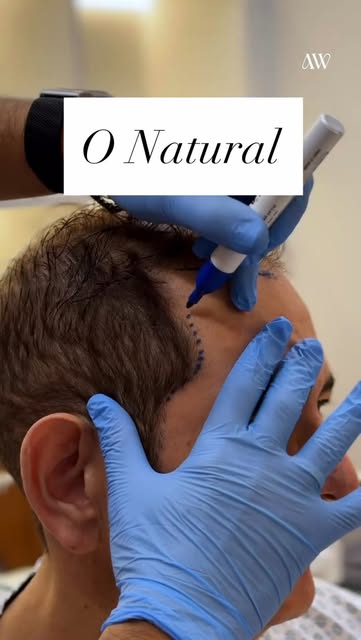 Naturalidade não acontece por acaso. Ela começa no planejamento.

No transplante capilar, cada detal