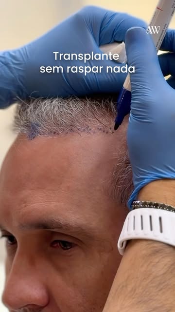 Naturalidade não acontece por acaso. Ela é planejada, fio a fio.

No transplante capilar, meu objeti