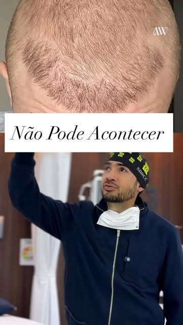 Isso não pode acontecer em um transplante capilar.

Um transplante pode ter muitos fios e ainda assi