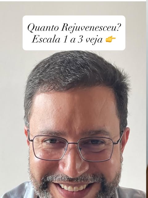 Transplante sem raspar nenhum cabelo. A maior revolução do transplante capilar moderno.

Desenvolvi 