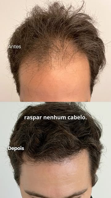 Natural perfeito. Sempre sem raspar os cabelos.

Essa é a essência do meu trabalho no transplante ca
