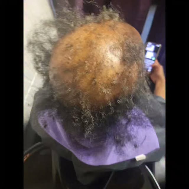 Watch This Amazing Hair Transformation ....... Custom Cranial Prosthesis #hairloss #cranialprosthesi