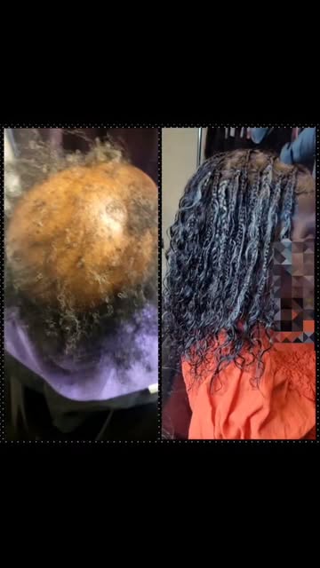 Watch This Amazing Custom Unit Alopecia Hair Transformation  #hairloss #alopecia #CranialProsthesis 