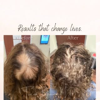 ✨ Hair restoration is a journey—not a one-size-fits-all treatment.

These before & after photos are 