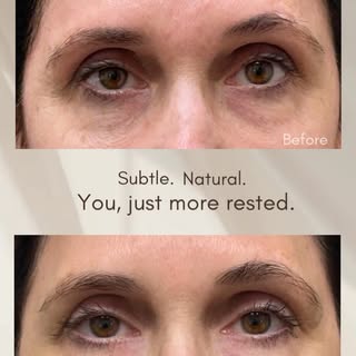 When the goal is for people to notice you, not your treatment.

Undereye rejuvenation with PDGF inje