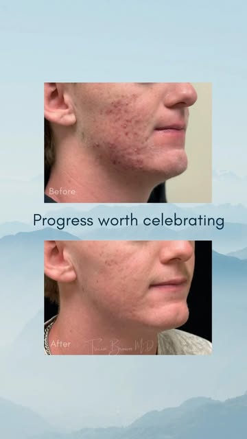 Acne treatment is not one-size-fits-all. The right treatment plan depends on the type and severity o