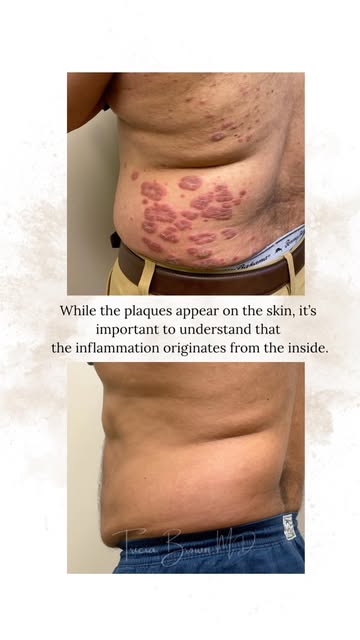 What you see on the outside is only part of the story. 

Understanding the inflammation behind psori