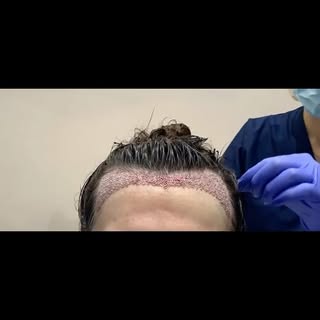 Lowering female hairline