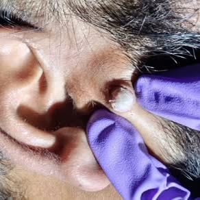 Sebaceous Cyst. Highly Recurrent Cyst. Gets infected all the time. It’s advisable to get it removed 