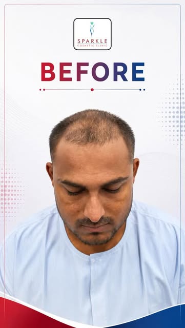 Tired of receding hairlines and thinning hair? 

Watch these unbelievable hair transplant transforma