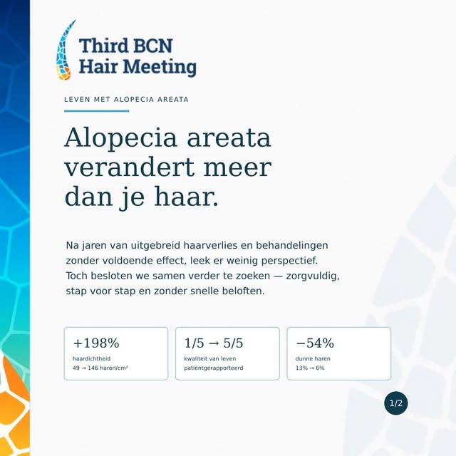 Alopecia areata verandert meer dan je haar.

Deze patiënte leefde sinds 2019 met uitgebreid haarverl