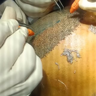 Advanced technology Keep Implanter -
Less handling of Grafts.
Accurate angle and direction of Grafts