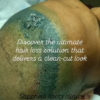 Quality solution to your hair loss problem Sapphire FUE hair transplant - sapphire roots clinic.