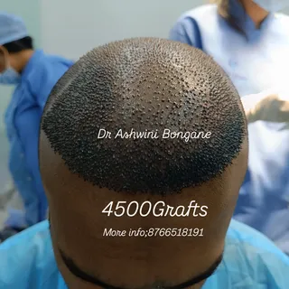 Sapphire roots Hair transplant;The channel opening phase of the FUE hair transplant technique is per