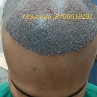 Sapphire FUE hair transplant .