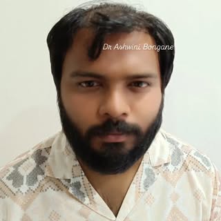 Restore your natural hairline with natural Density with advanced Sapphire FUE Hair transplant at Sap