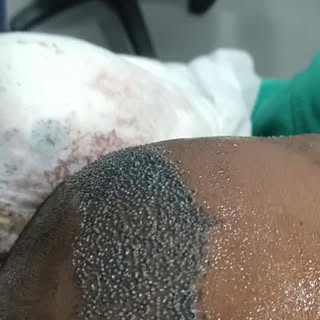 Restore your natural & High Density hair line with Sapphire FUE and (keep implanter )no root touch t