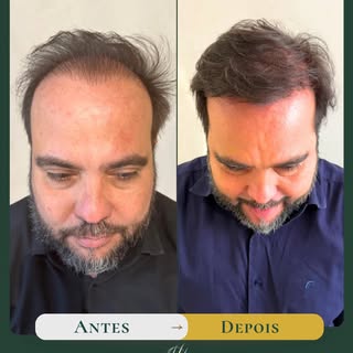 Esse paciente chegou com uma calvície frontal avançada, entradas profundas e o topo já comprometido.