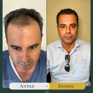O verdadeiro sucesso de um transplante capilar é quando ele passa despercebido.
Observe os detalhes 