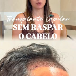 Sabemos que muitos adiam o transplante capilar por um único motivo: a impossibilidade de raspar a ca
