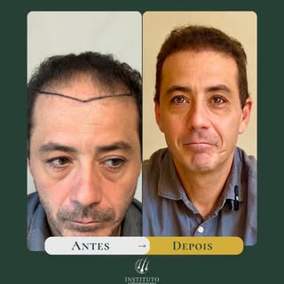 Fazer um transplante capilar é uma decisão importante, e a segurança no acompanhamento faz toda a di