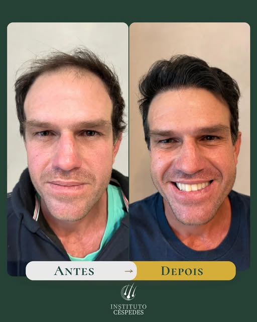 O impacto de uma única decisão após 365 dias. ⏳✨

Mais do que reparar no preenchimento da zona front