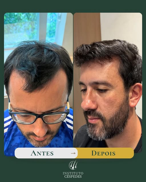 Muitos homens adiam o transplante capilar por um único medo: o resultado ficar artificial.
Este caso