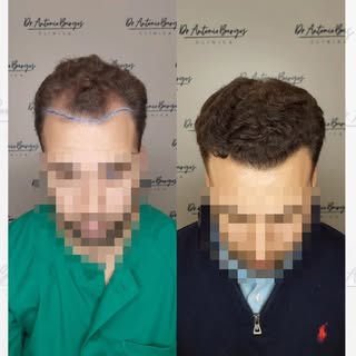 Otro caso de nuestra Unidad de Injerto capilar formada por @doctorantonioburgos y @drjcano . Densida
