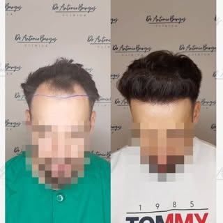 Nuestra Unidad de Injerto Capilar (@drjcano & @doctorantonioburgos ) lo volvieron a hacer !!! Nuevo 