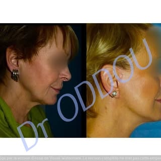 avant - lifting du visage - après.
 Lifting du visage associé à une lipostructure pour obtenir un ra