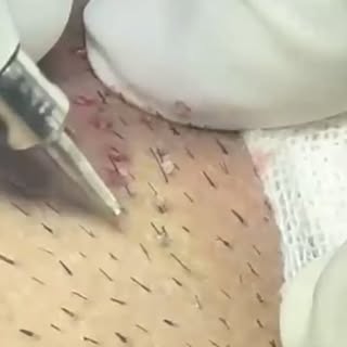 extracción de folículo