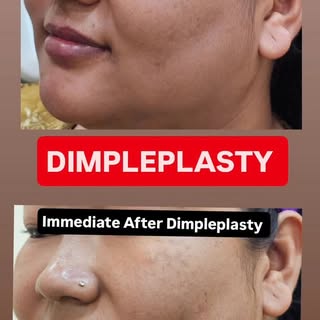Dimpleplasty Treatment 
#dermdynamicsskinhairanddlaserclinc #dranilkumarbhatta #dimpleplasty #aesthe