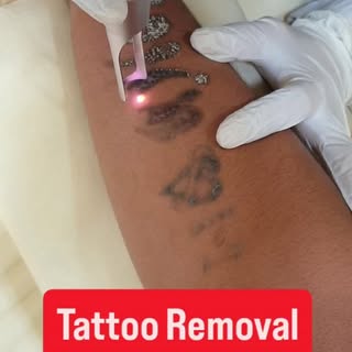 Tattoo Removal Treatment

#dermdynamicsskinhairanddlaserclinc #dranilkumarbhatta #tattooremoval #aes