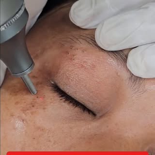 Co2 Laser Treatment for Syringoma 
#dermdynamics #skinhairandlaserclinic #dranilkumarbhatta #co2lase