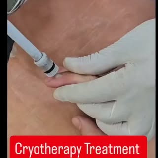 Cryotherapy Treatment for Wart 
#dermdynamics #skinhairandlaserclinic #dranilkumarbhatta #cryotherap