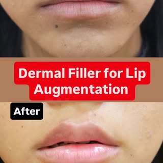 Dermal Filler for Lip Augmentation 
#dermdynamicsskinhairanddlaserclinc #dranilkumarbhatta #dermalfi