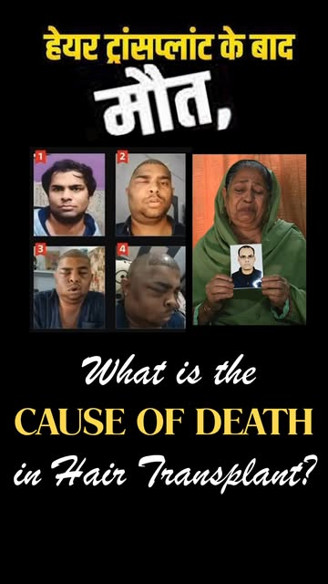 What Is the Cause of Death After Hair Transplant? 🤔

Is hair transplant surgery completely safe? Wh