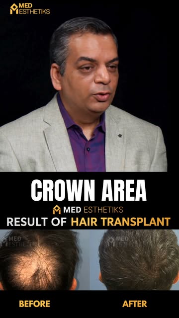 The crown area is one of the most common regions affected by hair thinning and baldness. But why doe