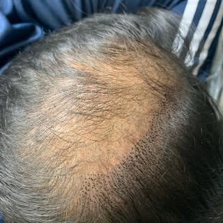 Half was through a density fill treatment 😎👌

Is your hair thinning and your not quite ready to sh